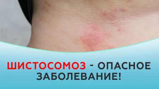 Шистосома: причины, симптомы и методы лечения